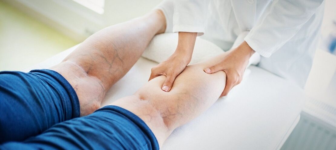 krčne žile na nogah in njihovo zdravljenje