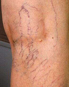 manifestacije krčnih žil na nogah