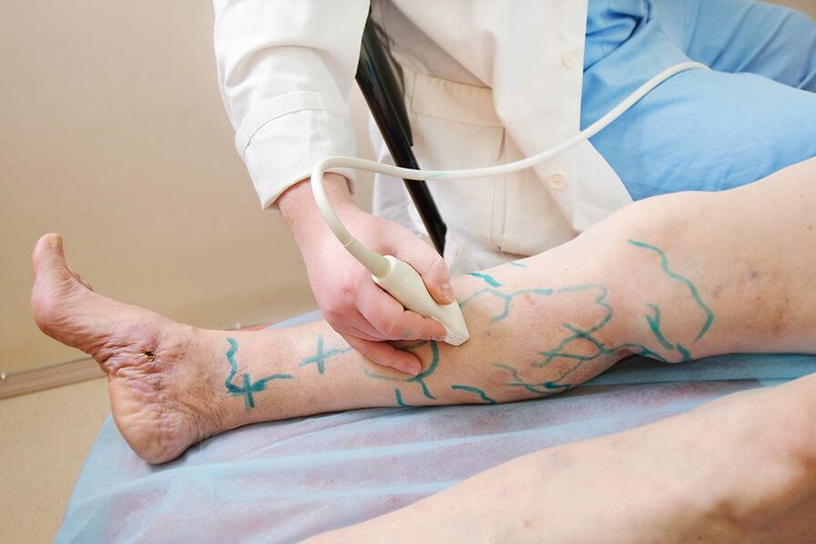 Priprava na miniflebektomijo - označevanje na perforatorjih spodnjega dela noge, izvajanje ultrazvoka